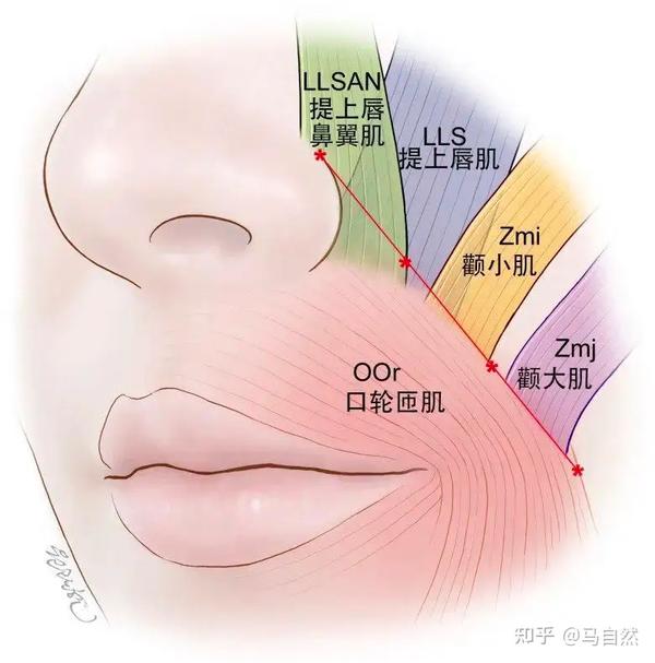 脂肪垫下垂堆积在鼻唇沟的位置