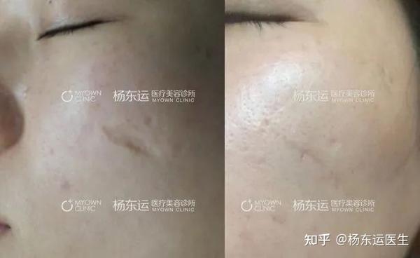疤痕切缝恢复的全过程是什么样子? - 知乎