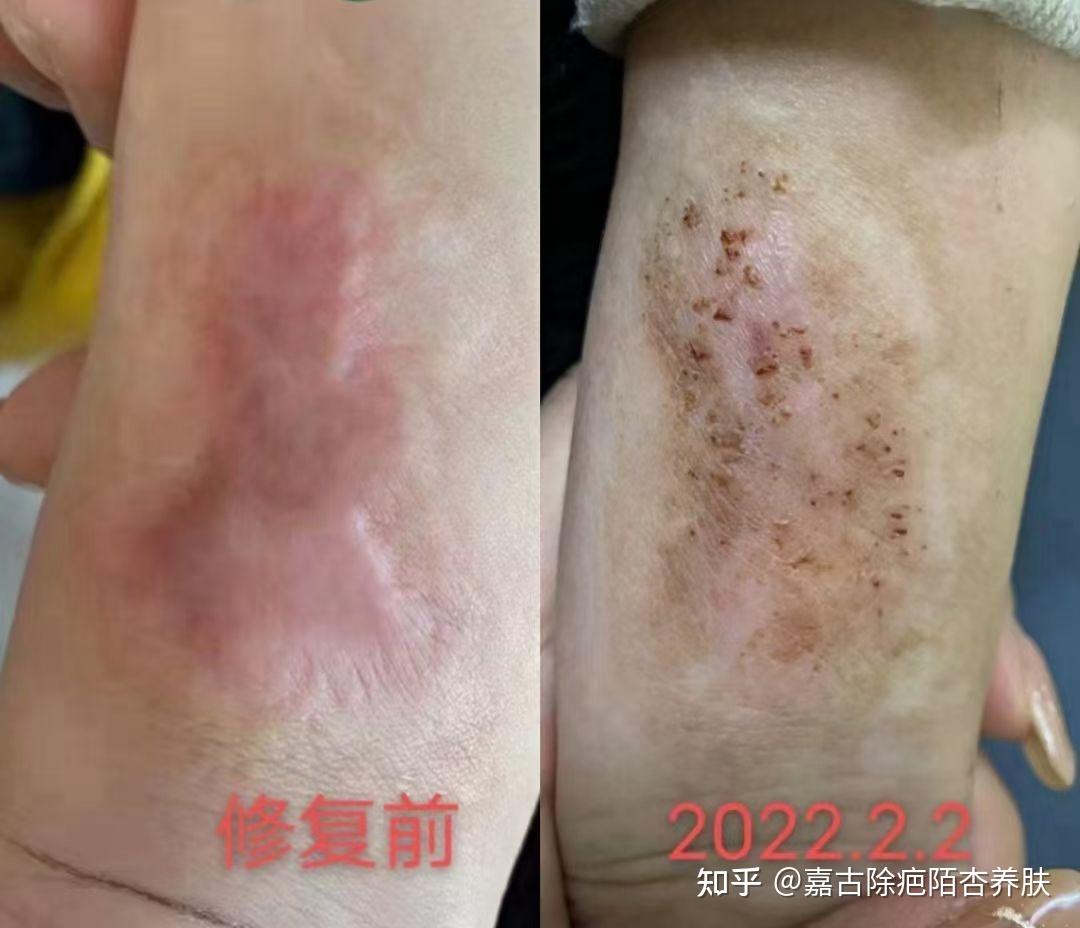 嘉古除疤增生疤痕修复篇