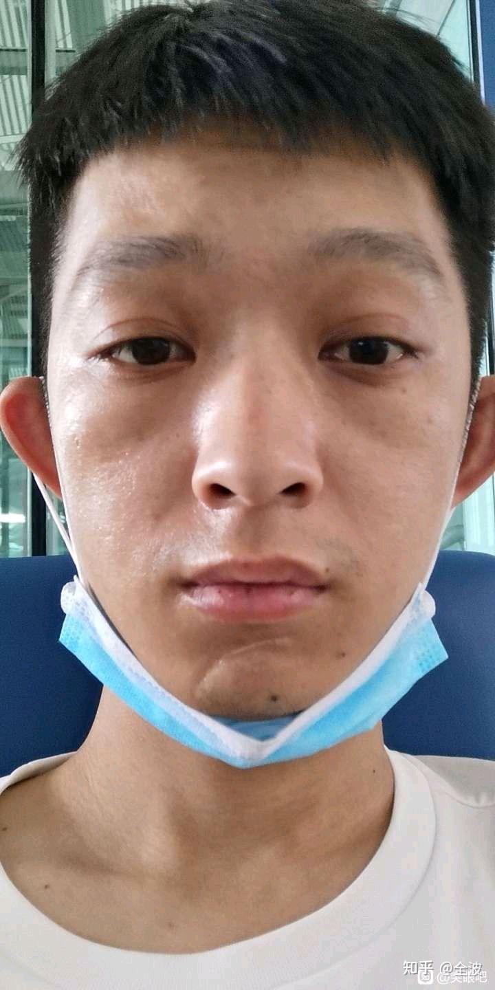 甲亢突眼–眼眶减压术给病友们参考