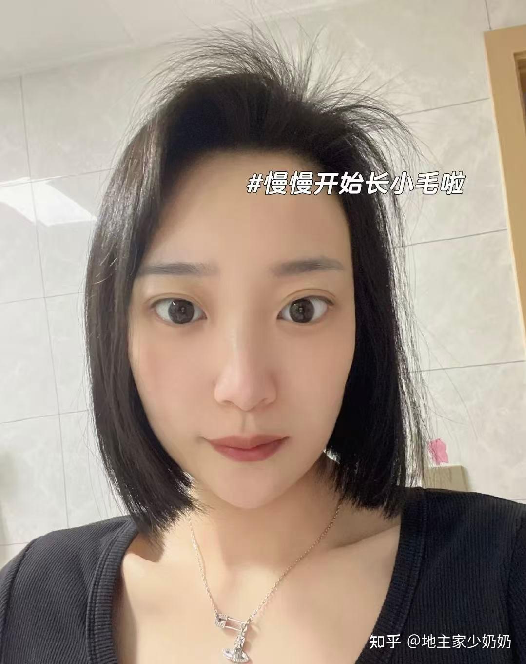 怎么科学改善脱发,让头发变多,最快最有效? - 知乎