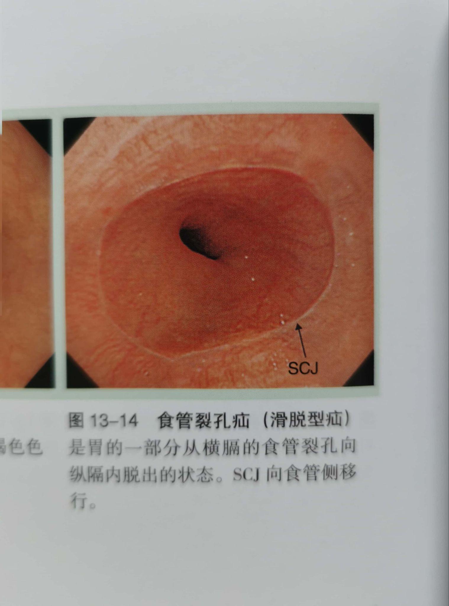 正常人的胃镜食管图片图片