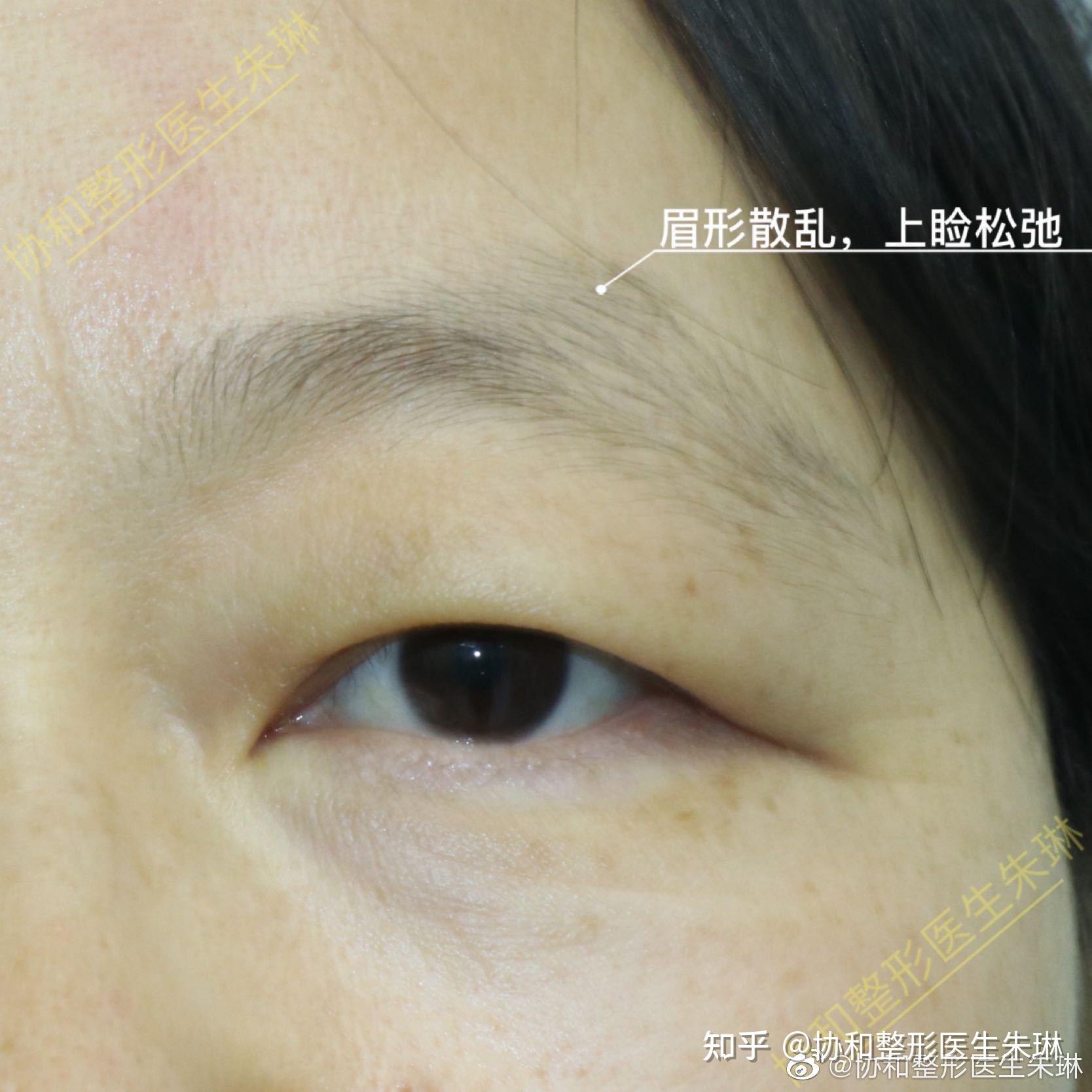 切眉后的疤痕如何通过纹眉改善 - 知乎