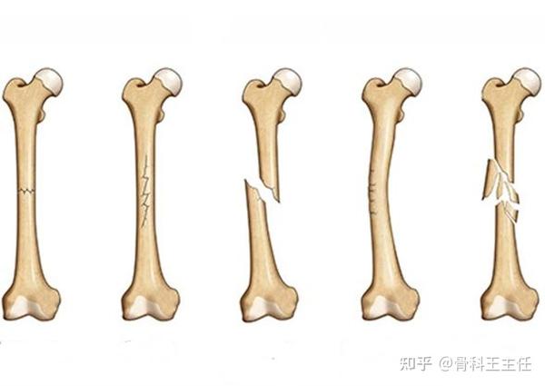 骨折后别慌,出现这4个迹象,说明正在正常愈合中 - 知乎