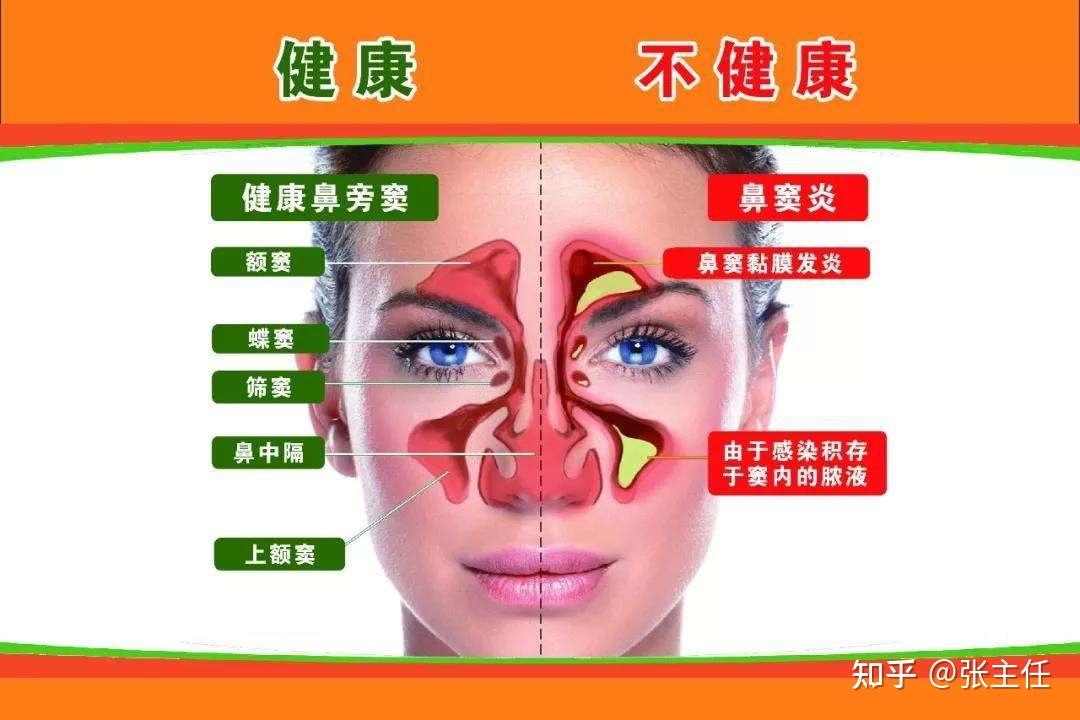 鼻窦炎怎么治疗能够根除？从医50年余年老中医教你这这样做，鼻窦炎远离你！ - 知乎