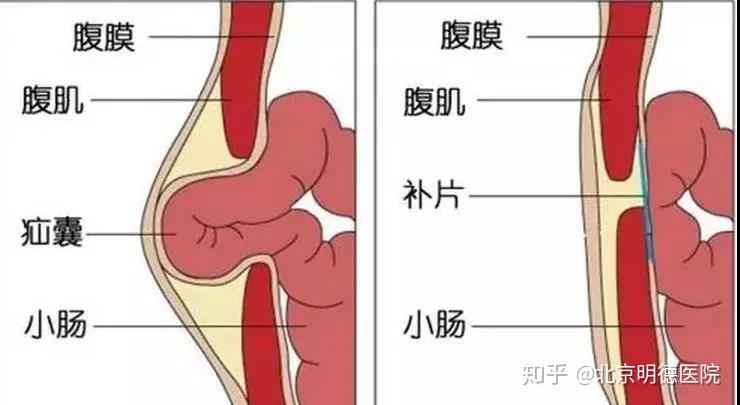 專家當心小腹鼓包預防疝氣從生活習慣開始