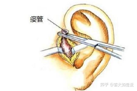 耳前瘘管内部结构图图片