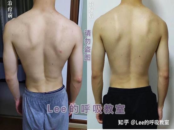 发现脊柱侧弯怎么办!(预热,下篇文章详细讲) - 知乎