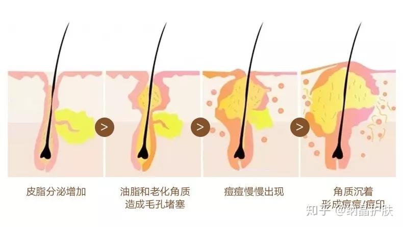 为什么反复爆痘的总是我?原因竟然是...... - 知乎