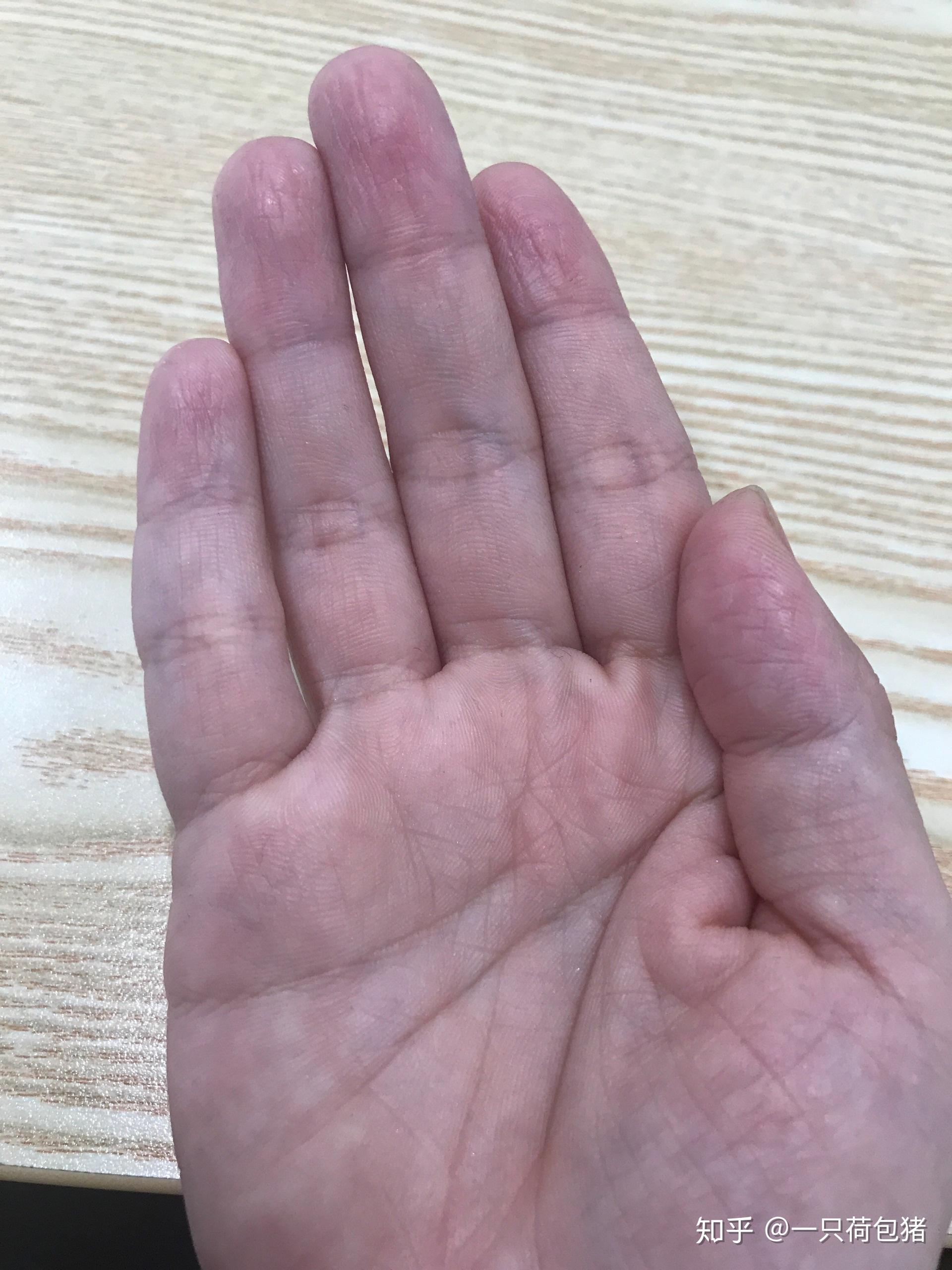 这是什么皮肤病手指干燥脱皮