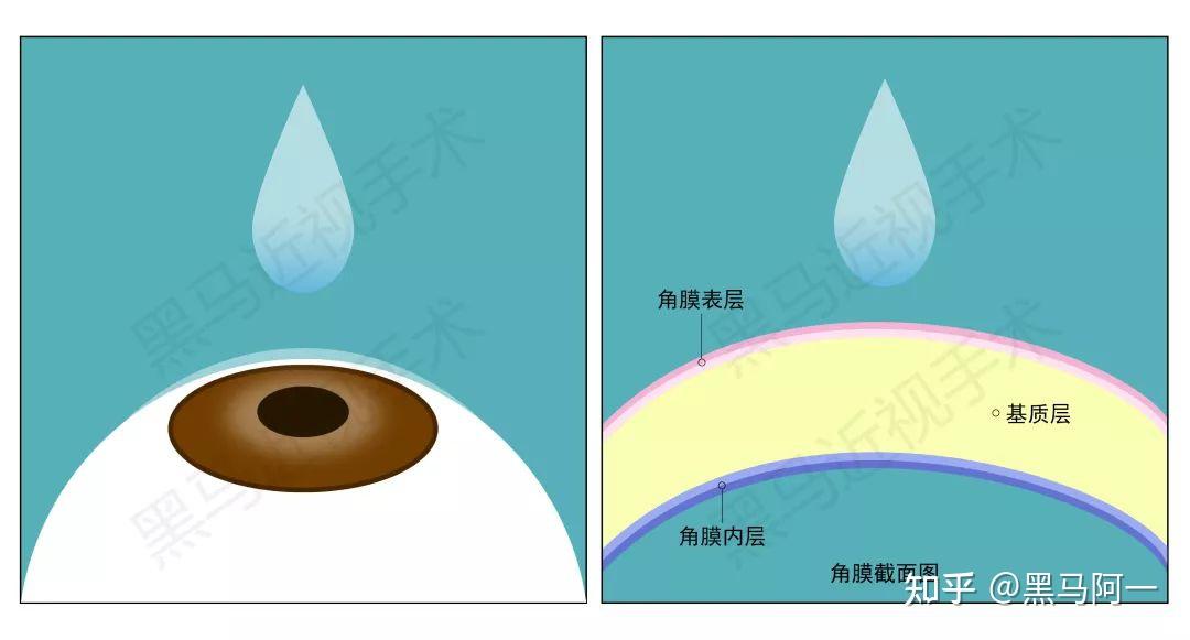 專家支招寫給近視手術選擇困難的你