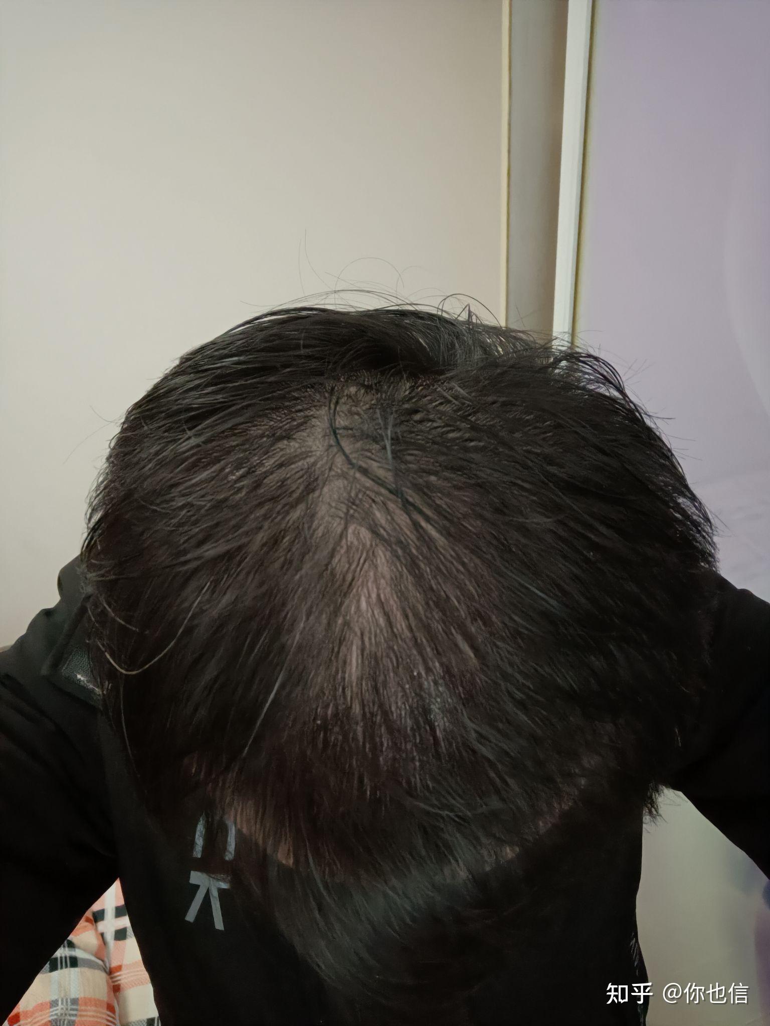 三个多月从快秃顶到正常发量幸好在治疗脱发上我没有走弯路感谢知乎