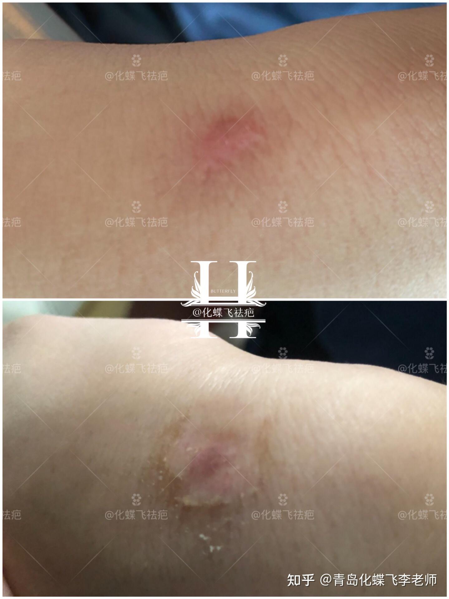 孩子手腕上的增生疤痕 - 知乎