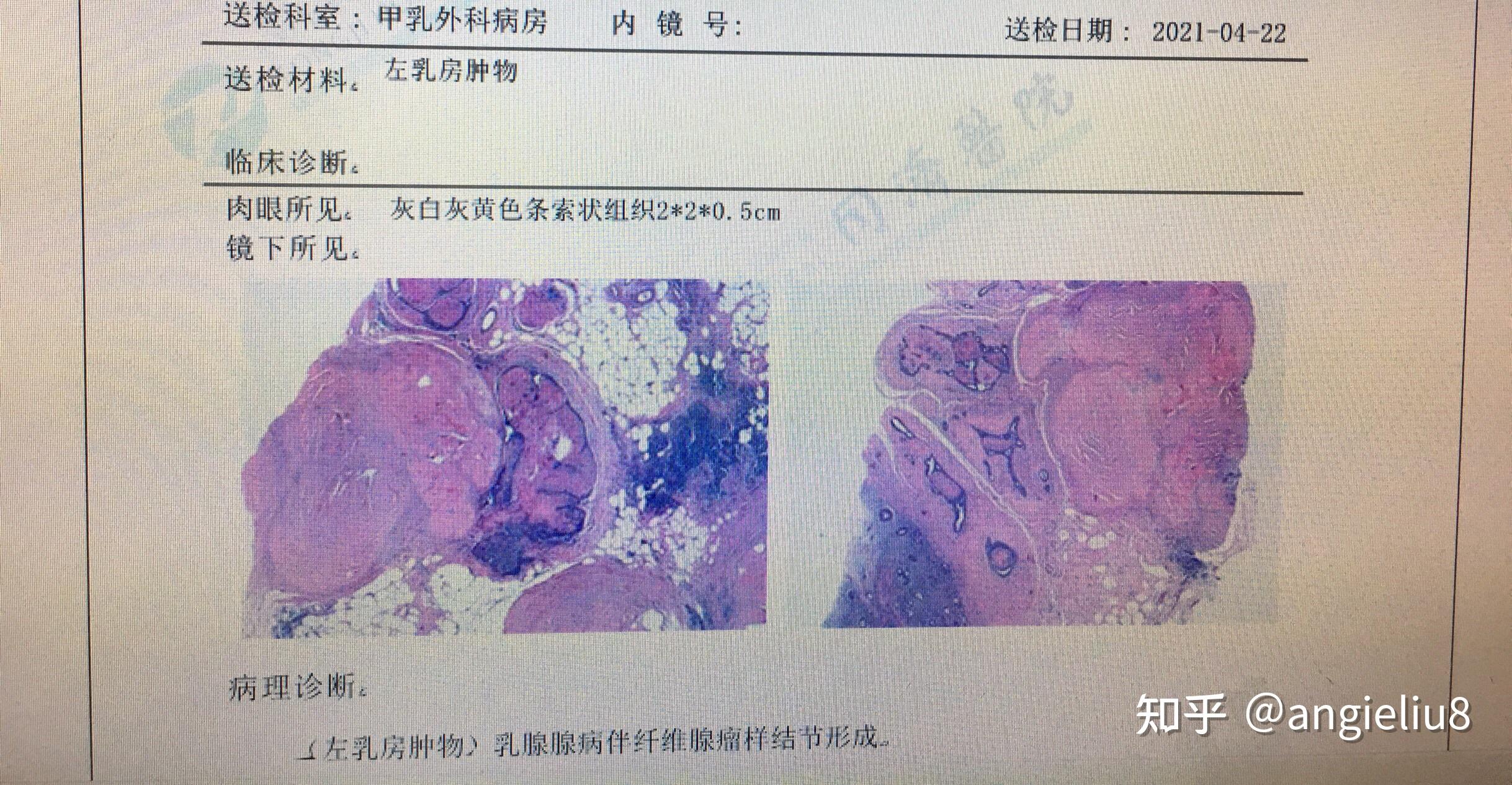 乳腺彩超4c微創穿刺病理良性