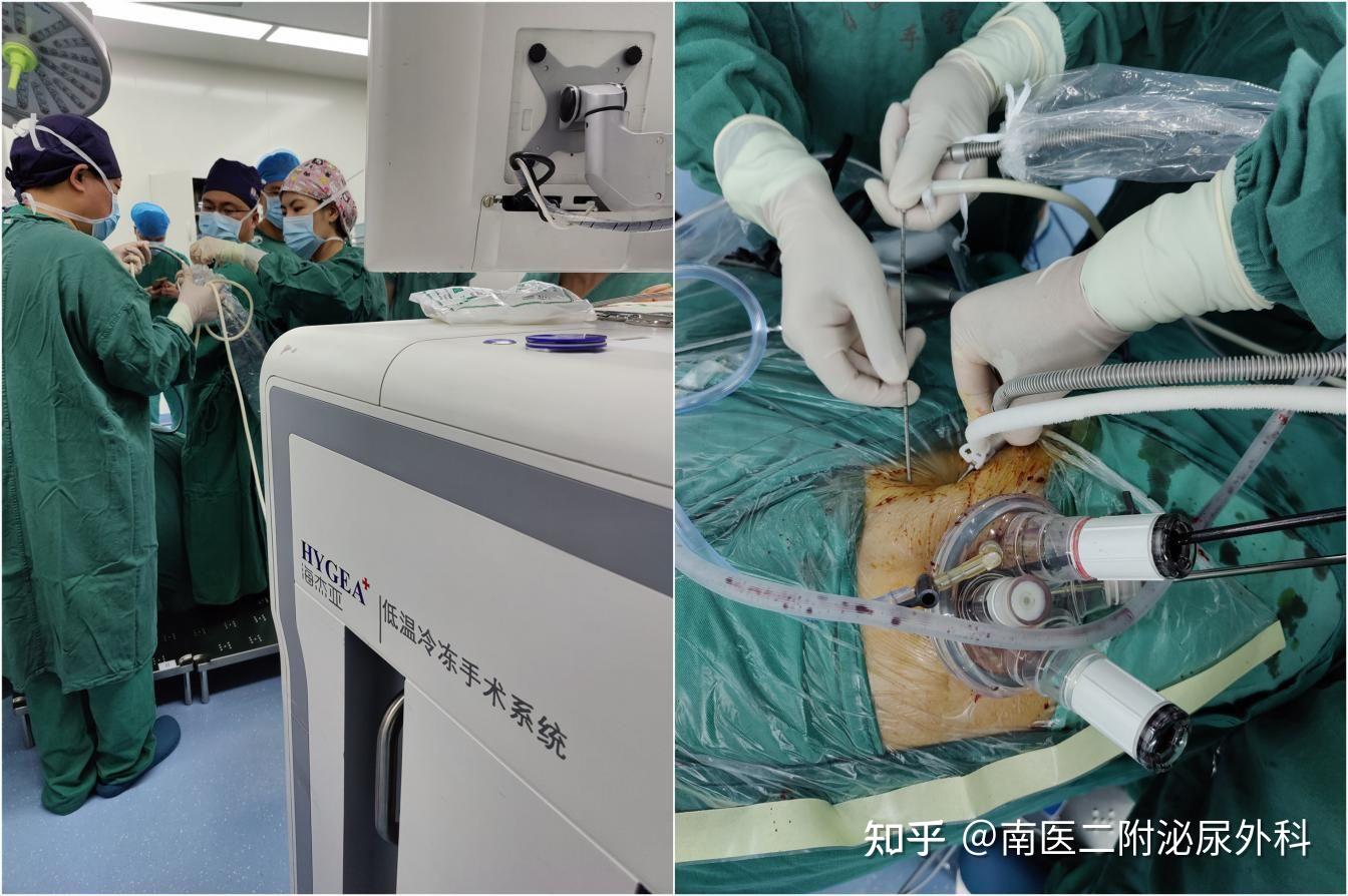 "冰火两重天",单孔下"康博刀"为难治性肿瘤患者带来 福音