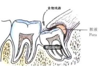 智齿冠周炎要不要拔牙? - 知乎