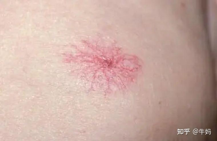 85肝癌患者发现时已到中晚期如何预防和早期发现端倪