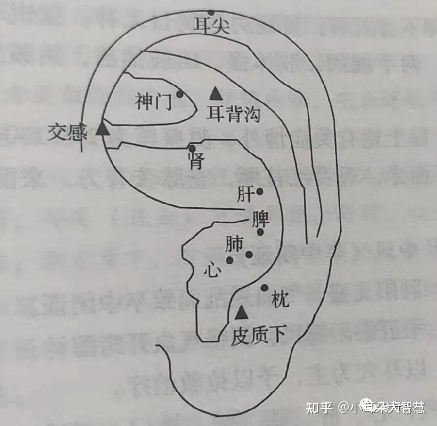 脾,肺,腎,枕,神門,交感,皮質下,耳背溝,耳尖(放血)【治則】平肝清熱