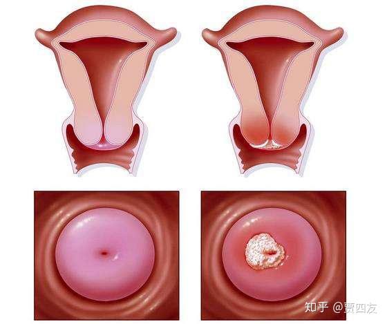 hpv阴起宫颈炎的治疗方法