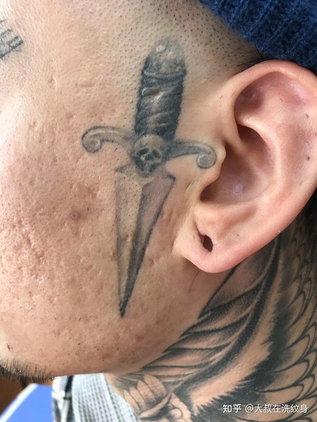 正确引导和科普洗纹身知识,以及更安全的无菌操作更为重要,洗纹身不