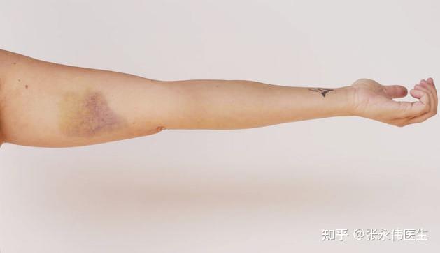 第四,血栓性静脉炎,由静脉输液和注射引起的渗出第五,抑制疤痕的形成