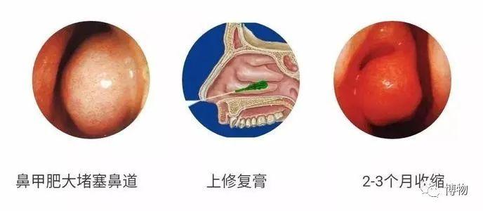 要是连药物都不起作用,就只好动刀子切除部分鼻甲,来改善鼻子的拥堵