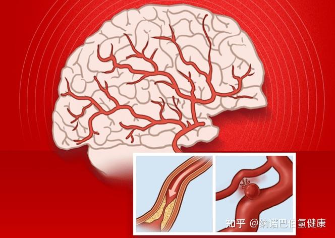 血栓在腦部血管堵塞會導致