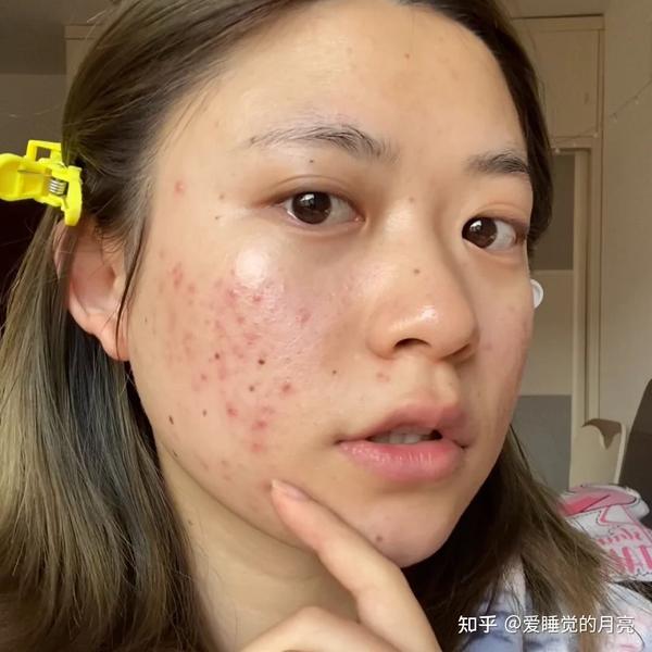 麻子脸到女神的蜕变!