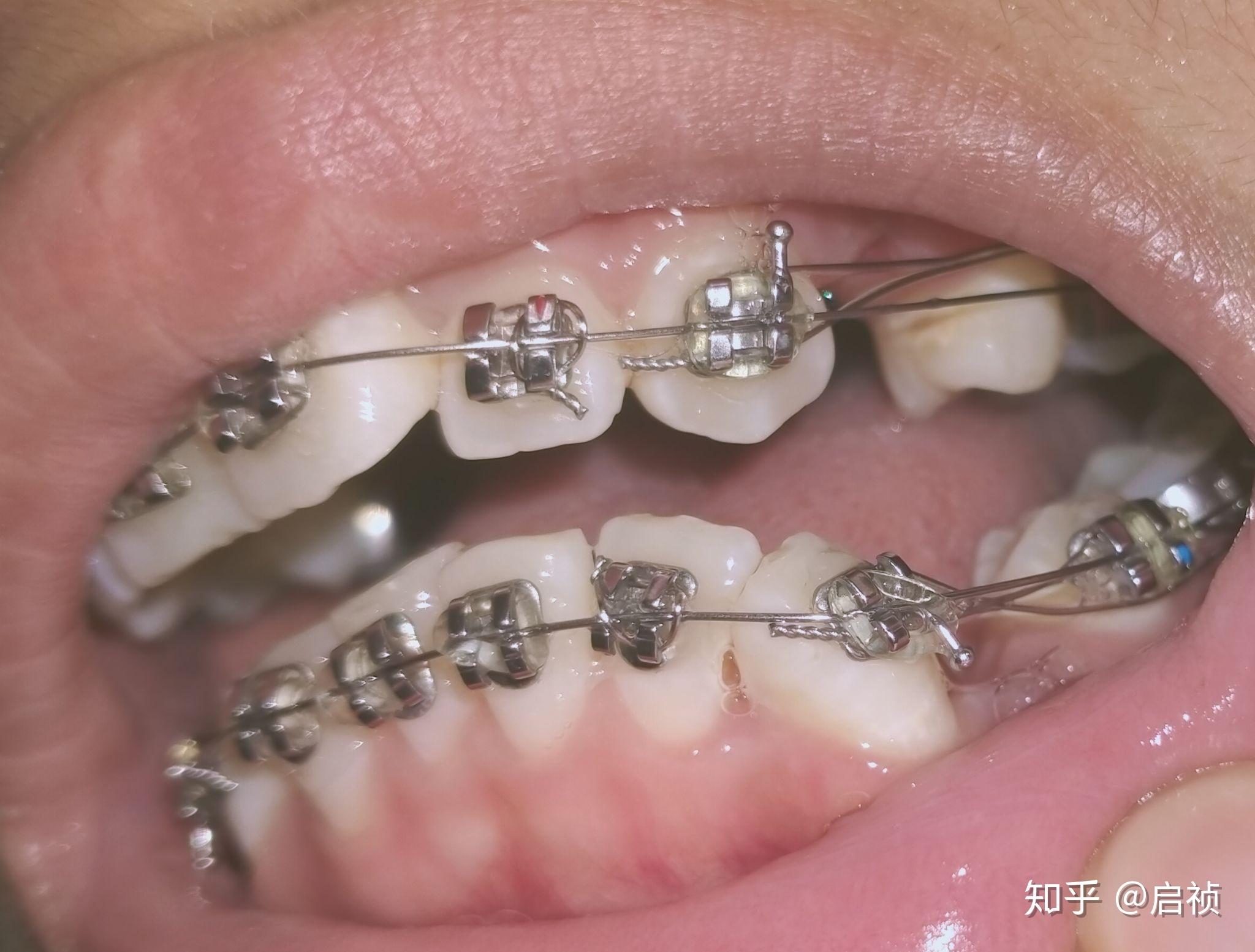 请各位专业人士帮忙看一下这样属于侧面龋吗?目前正畸中