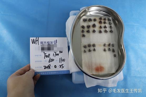 这就是从我后脑勺取下来的毛囊,也就是要"搬个家",我也是后来才收到徐