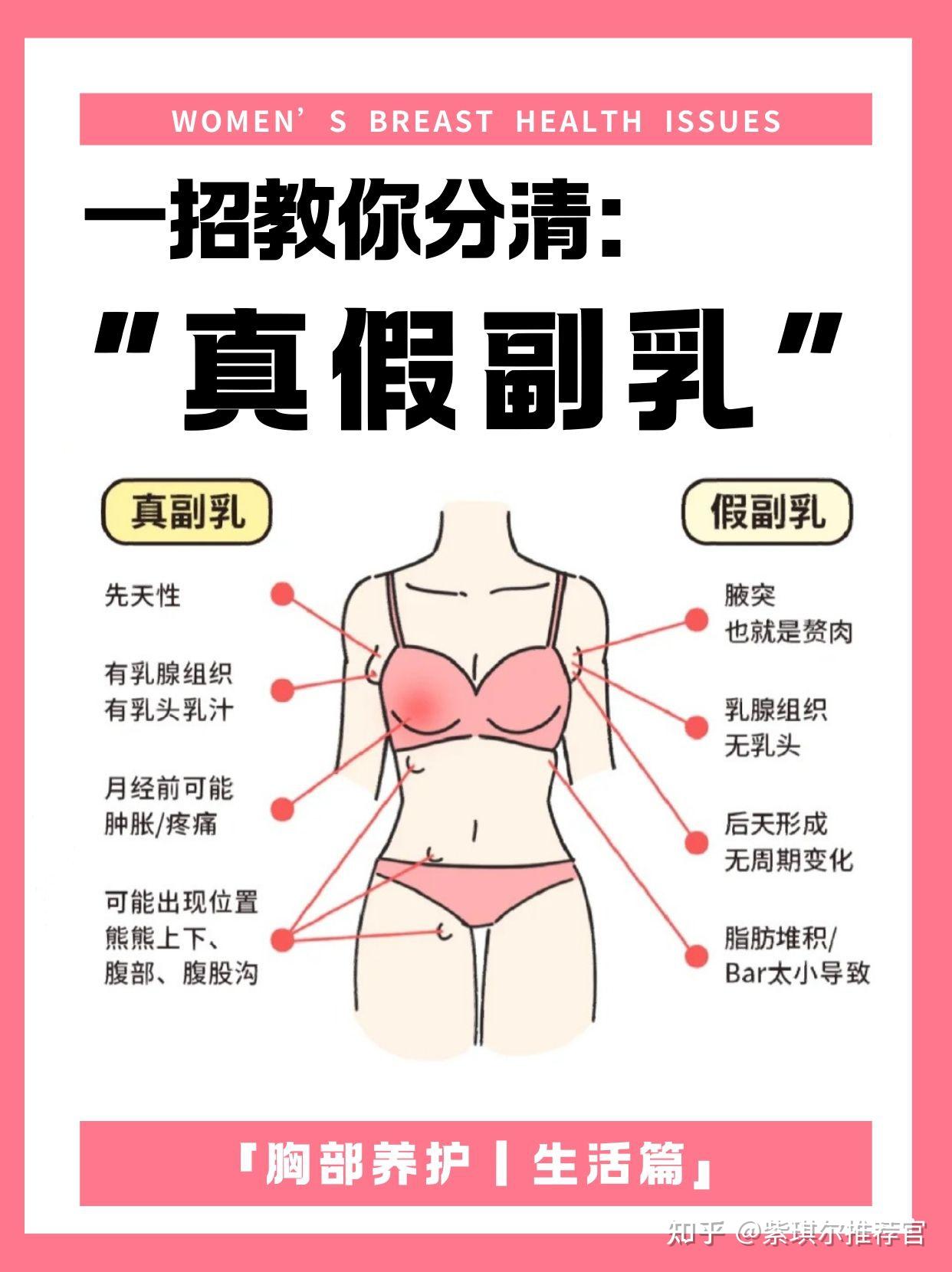 副乳图片长在什么位置图片