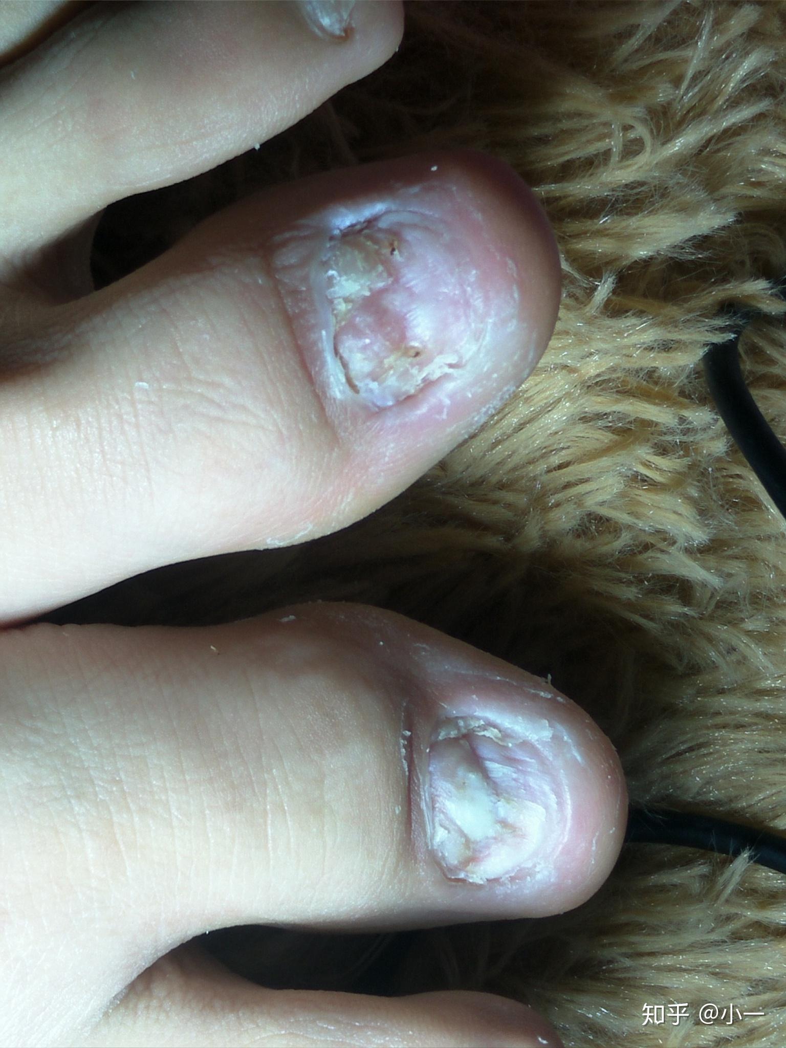 这是目前没抹药的状态,指甲周围皮肤变白了,左边指甲上黑色的东东是我
