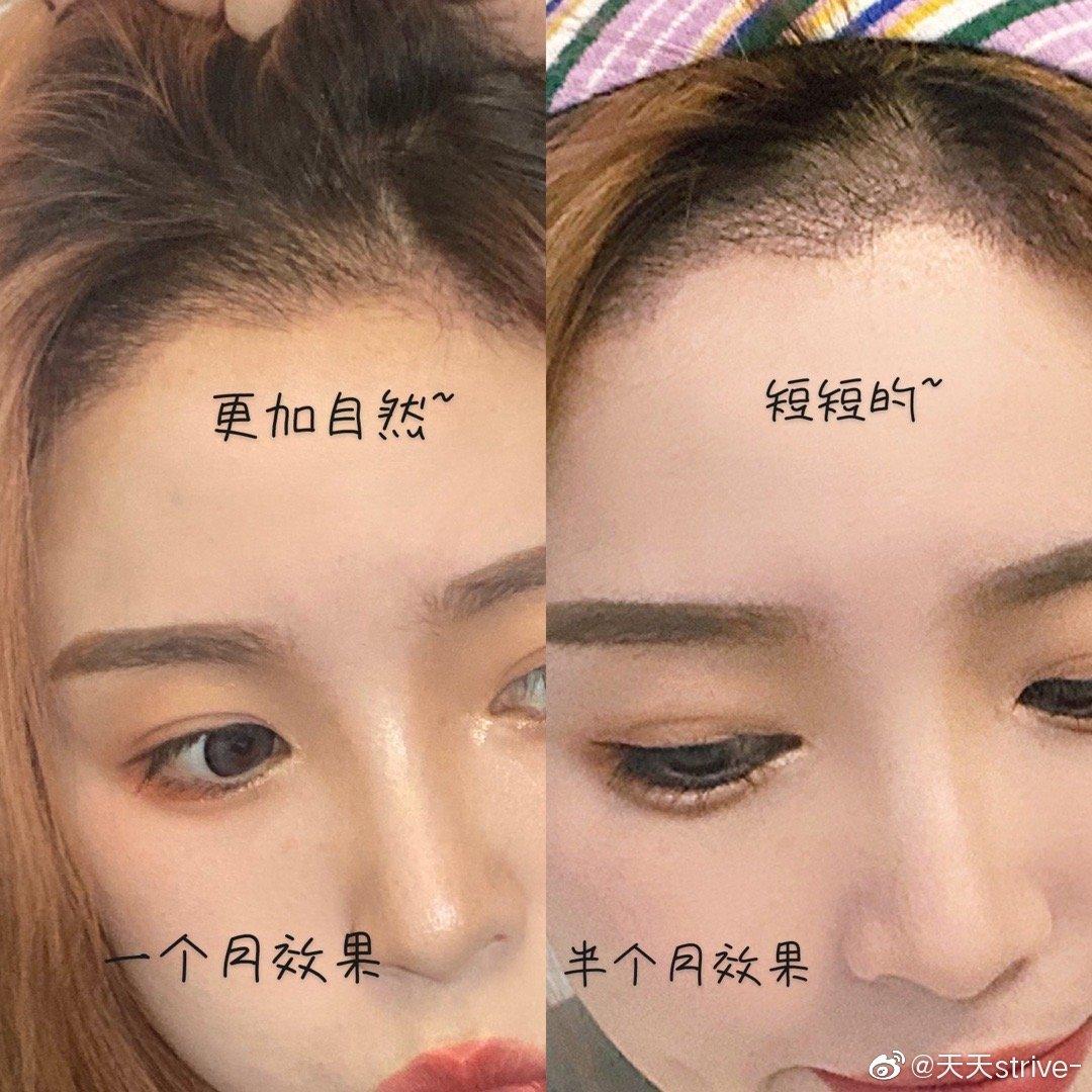 植发后不会茂盛(植发后不会茂盛怎么办)