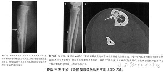 造釉细胞瘤ct图片图片