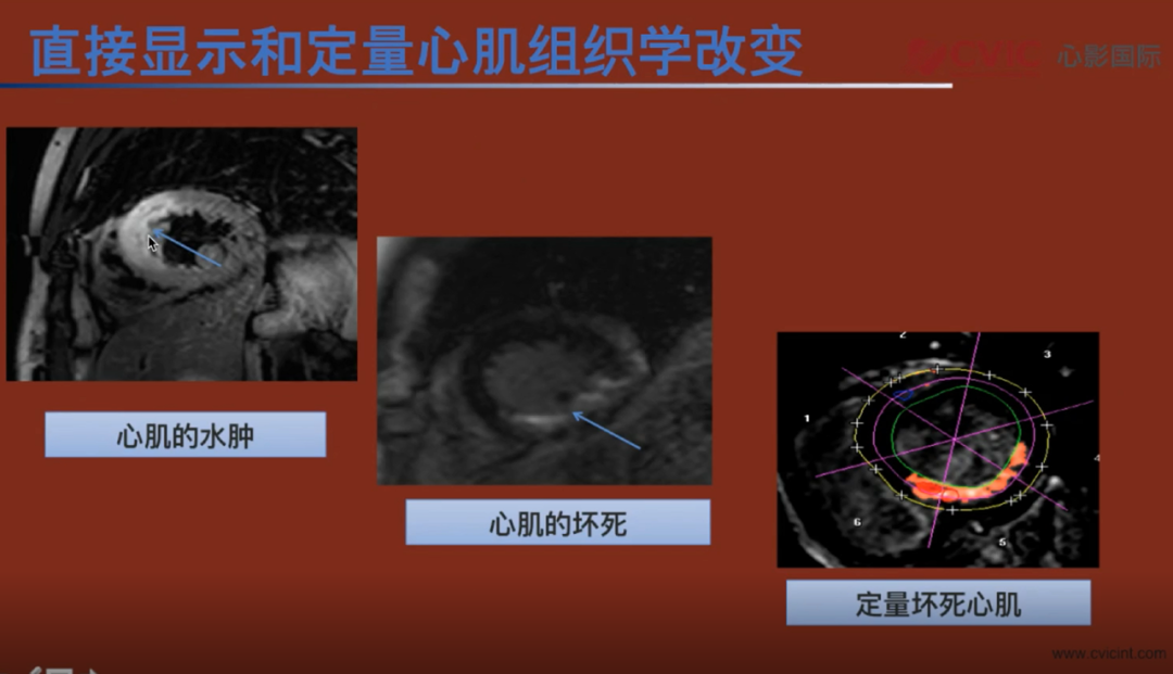 cvic心影国际葛恒老师cmr心梗术后评估与无创冠脉mra的临床应用