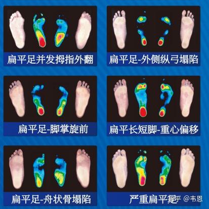 扁平足怎么办?教你一招.