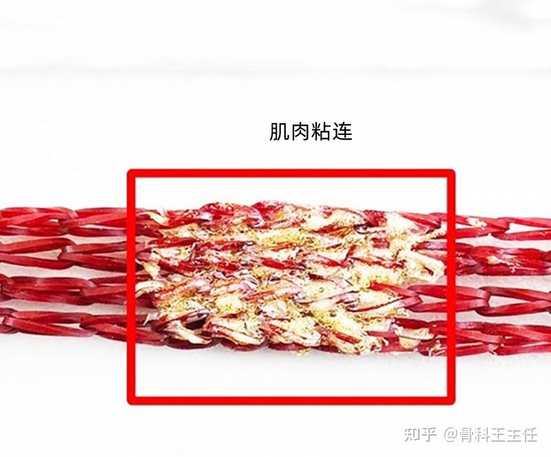 受伤或骨折后,肌肉疼痛发硬,什么是肌肉粘连,怎么办? - 知乎