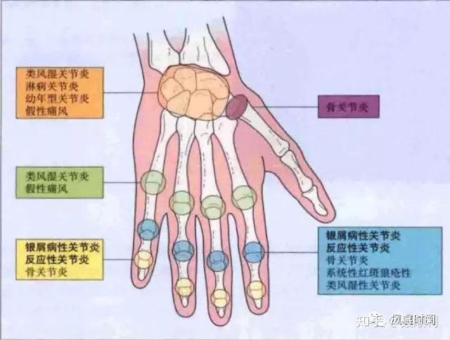 6 大类易误诊为「类风湿关节炎」的疾病