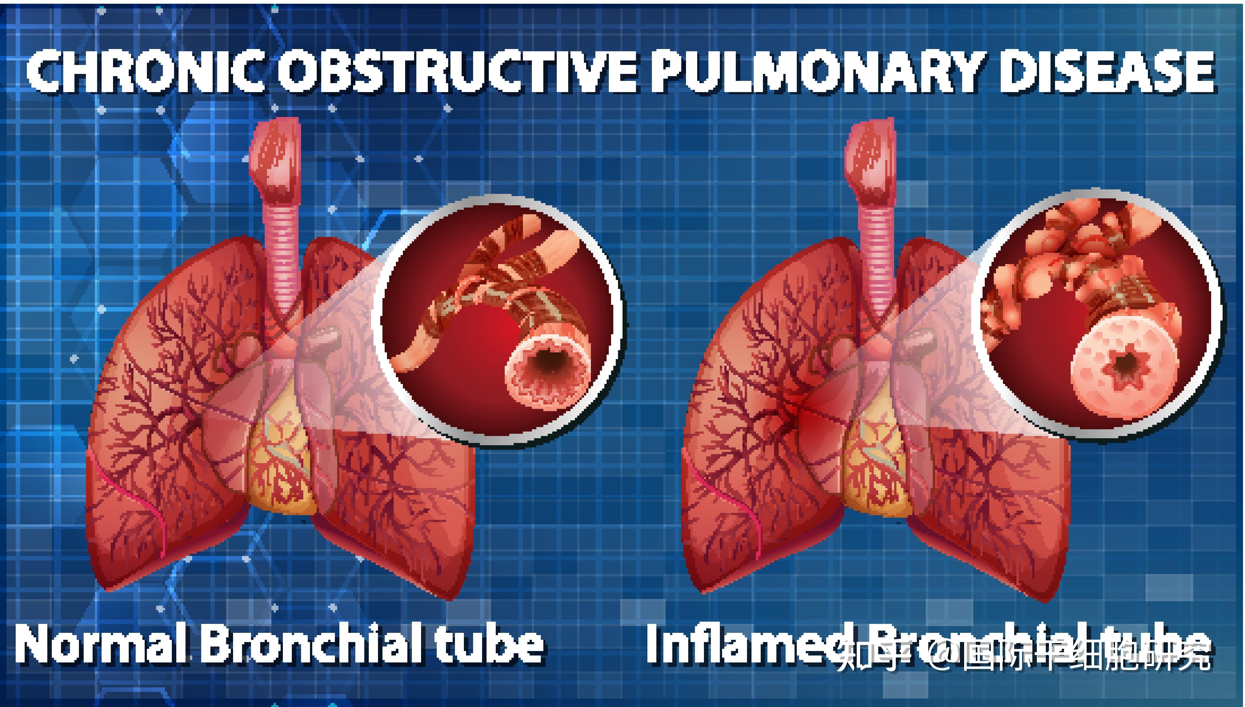干细胞助力慢性阻塞性肺病患者，重获呼吸自由 知乎