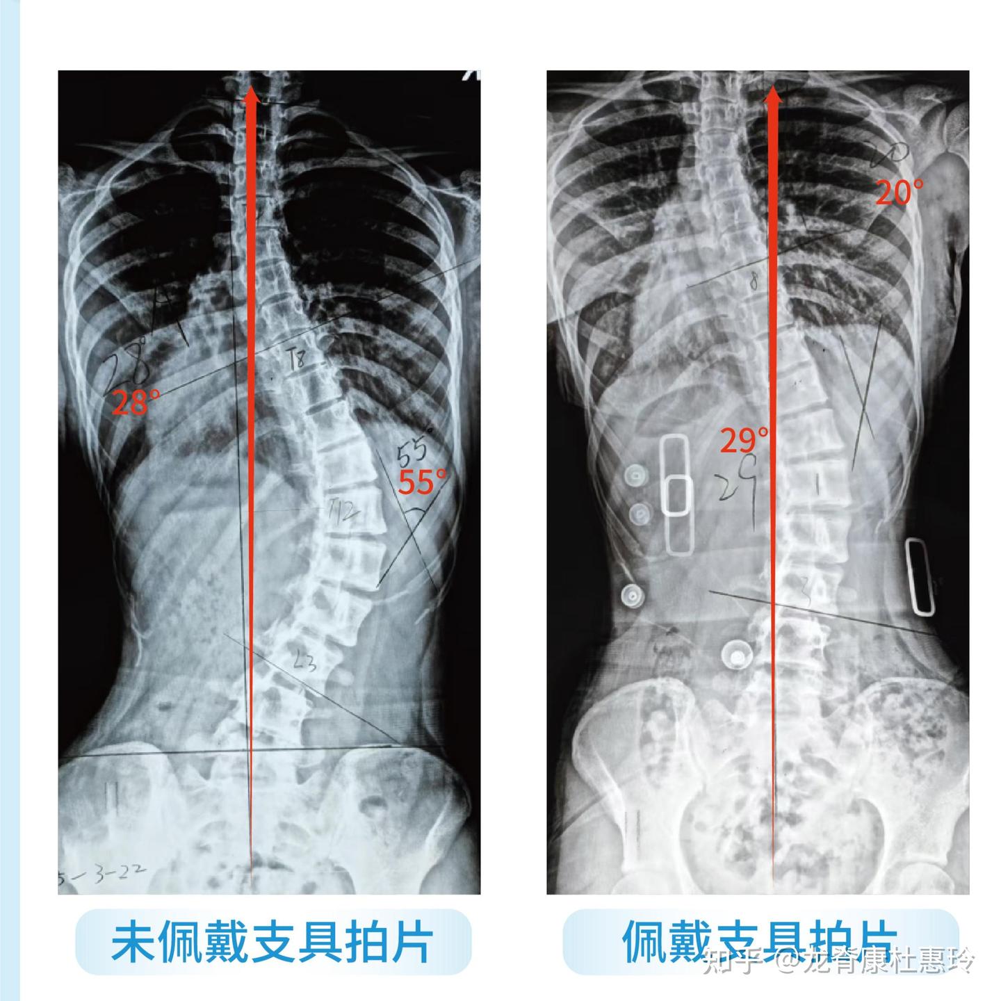 警惕加重脊柱侧弯的“平背”!学会3个动作帮助恢复生理曲度 - 知乎