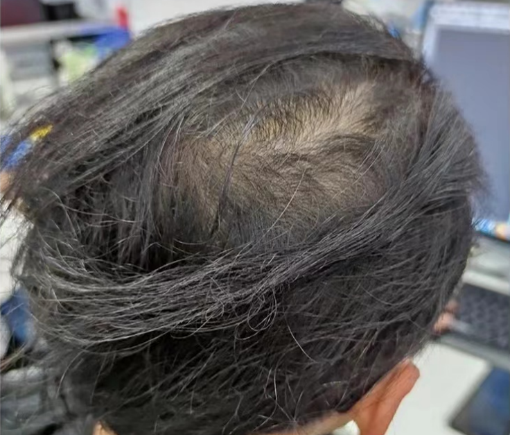 男生头发油腻,掉发越来越严重了,用控油,防脱洗发水真的有用吗?