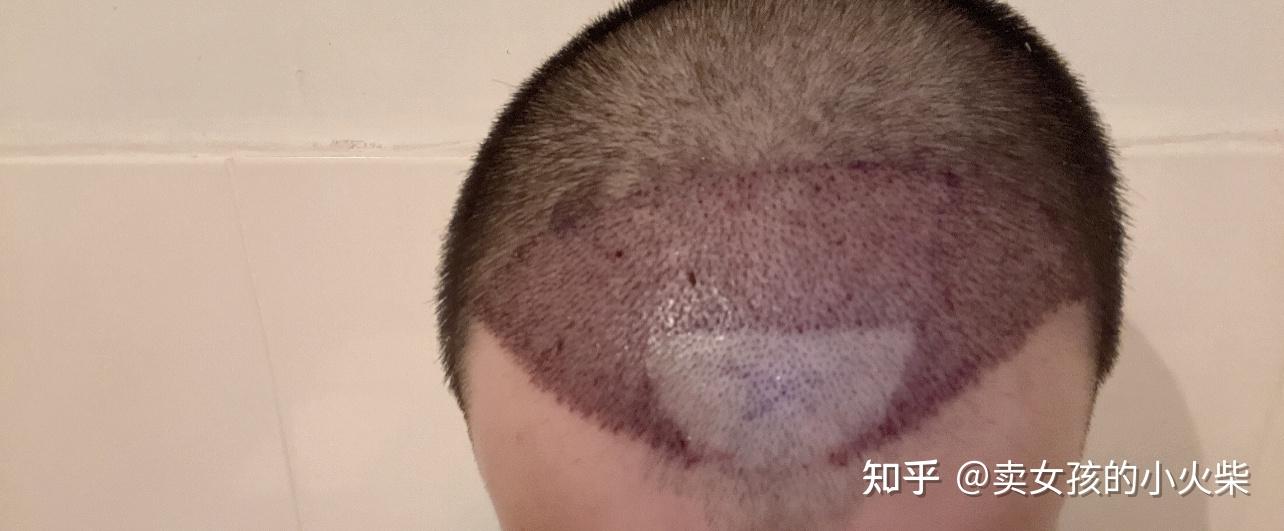2020广州植发(广州植发的价格一般是多少)