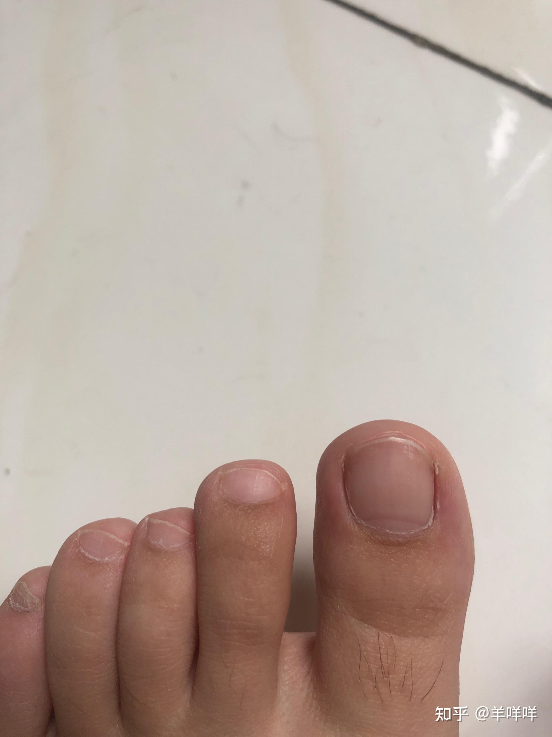 甲分离型灰指甲治愈过程