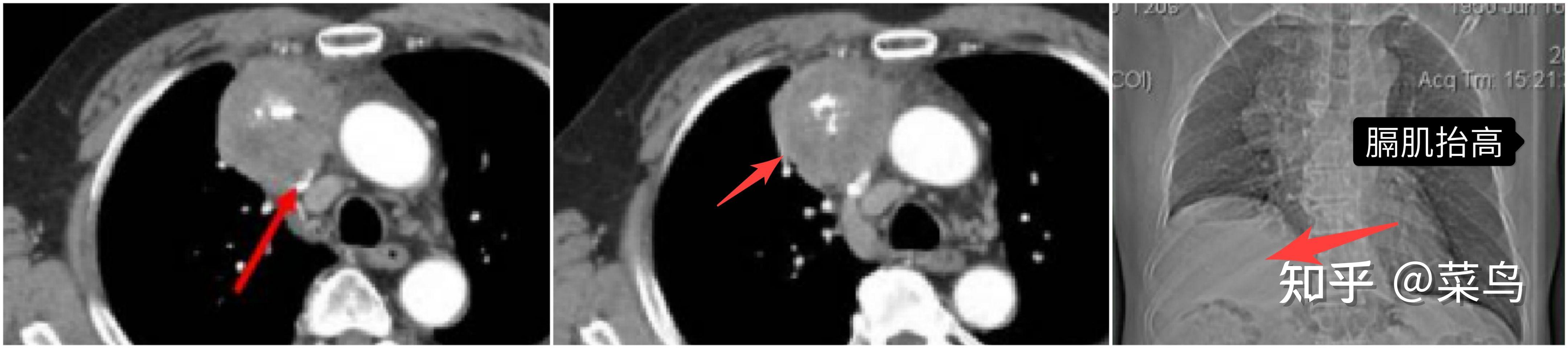 胸腺肿瘤的病理和影像学诊断（胸腺瘤篇） - 知乎