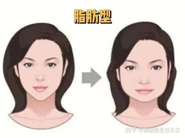 我不是胖,我只是发腮了……人到中年都害怕的发腮到底是什么? - 知乎
