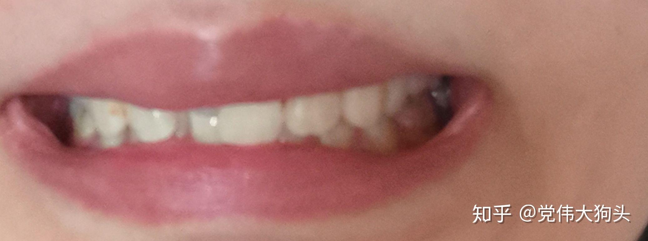 牙齿不齐+右上门牙折断+开唇露齿进行牙齿矫正！ - 哔哩哔哩