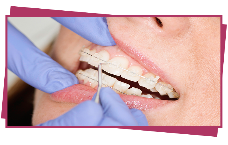 成人正畸:需要坚持才会蜕变的矫正时期