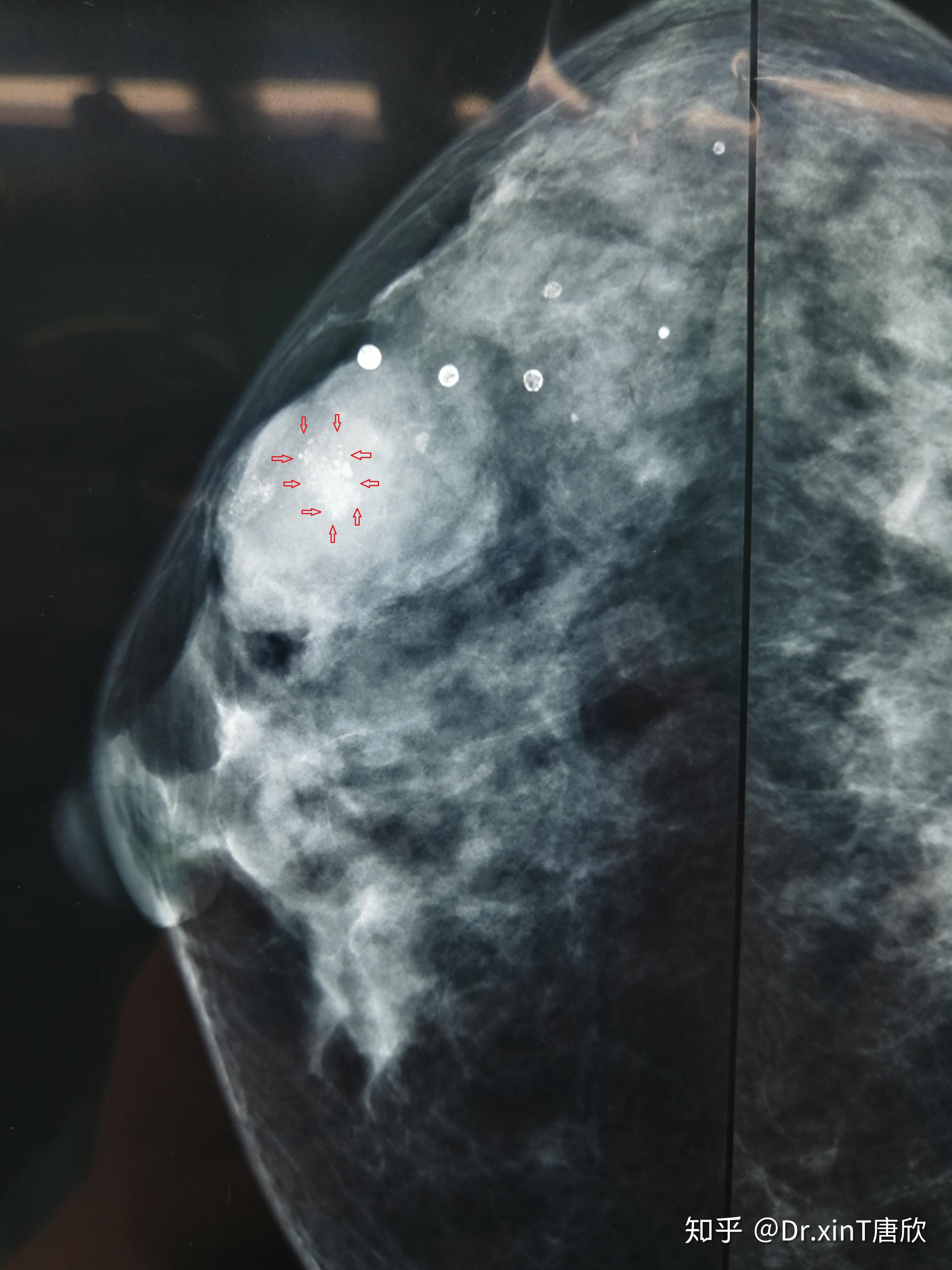 明显的肿块影,以及肿物内的不规则泥沙样钙化(红色箭头内)术前钼靶:术