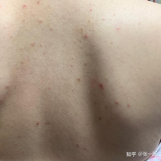 怎样不长痘痘皮肤好 v2-fa34272c298d05be6fce146a84973af0_r.jpg