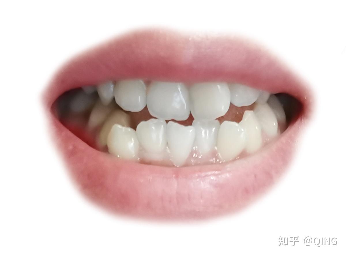 坐标北京我的牙齿矫正日记期待变美的那一天